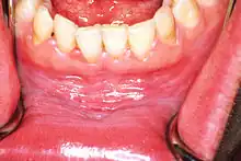 Leukoplakia in the lower labial sulcus