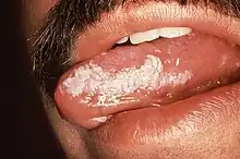 Leukoplakia on the side of tongue