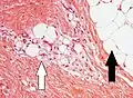 Lipoblasts (white arrow) and lipocytes (black arrow), in a case of lipoblastoma