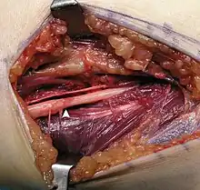 Operating field after removal of the lipoma: Arrow marks the median nerve that was compressed by the lipoma.