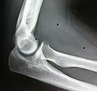 X-ray of a lipoma