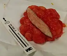 This lipoma was removed from the thigh of a 39-year-old male patient. It measured about 10 cm in diameter at the time of removal. In the center is a section of skin which was removed with the lipoma.