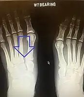 Lisfranc dislocation of the left foot due to lisfranc ligament rupture as seen on bilateral weight bearing radiographs.