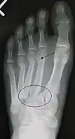 Lisfranc fracture (marked by the oval). This case also has fractures of the distal second (marked by the arrow), third, and fourth metatarsal bones.