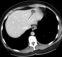 A liver hemangioma as seen on CT