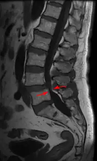 MRI of a lumbar spinal stenosis L4-L5. L4-L5 antherolisthesis of grade I. Hypertrophy of interspinous ligaments in relation to Baastrup's disease.