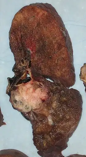 A squamous-cell carcinoma (the whitish tumor) near the bronchi in a lung specimen
