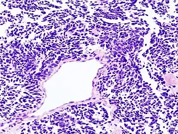 Histopathologic image of small-cell carcinoma of the lung. CT-guided core needle biopsy.