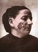 Lupus vulgaris in a woman in 19th century