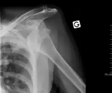 An anterior dislocation of the shoulder