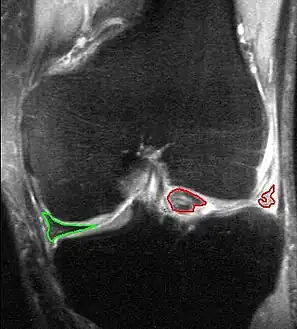 Bucket-handle tear of the lateral meniscus (red). Medial meniscus intact (green). MRI, coronal T2 *-weighted GRE sequence.