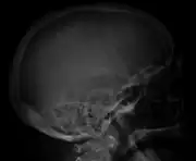 Skull X-ray showing multiple lucencies due to multiple myeloma