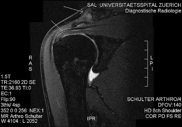 MRI showing subacromial impingement with partial rupture of the supraspinatus tendon, but no retraction or fatty degeneration of the supraspinatus muscle.