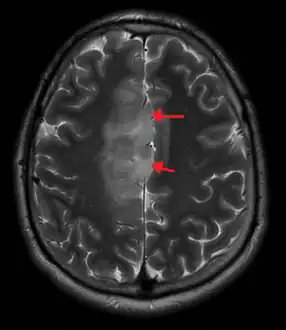 A oligoastrocytoma on MRI