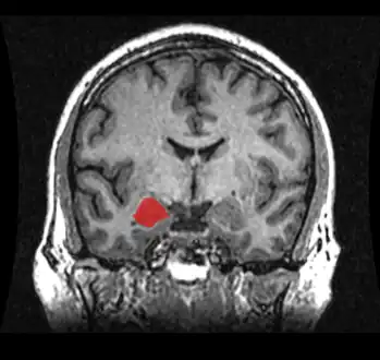 T1 weighted MRI scan of a normal coronal section of human brain with amygdala marked in red.