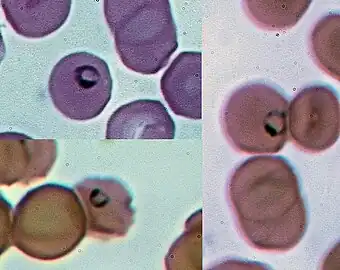 Ring forms of Plasmodium inside human red blood cells (Giemsa stain)