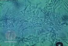 Microscopy: Malassezia spores (S) and filaments ("spaghetti and meatballs appearance")