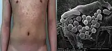 Appearance: Pityriasis versicolor in a man. Electron micrograph: round Malassezia spores (S) and filaments