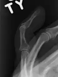 A mallet finger without an associated fracture
