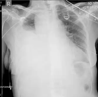 Right showing a massive right hemothorax
