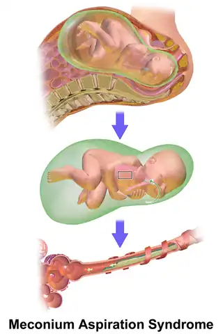 Release of meconium into the amniotic cavity and then intrauterine gasping of post-term neonates may cause meconium aspiration syndrome.