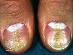Median canaliform nail dystrophy of Heller