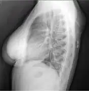 X-ray showing lipoma