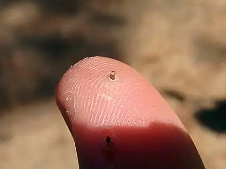 Mediterranean black sea urchin sting being expelled from the body by itself after three weeks