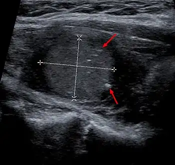 Medullary thyroid carcinoma on ultrasound with typical small calcifications (arrows)