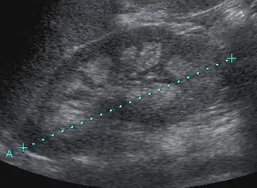 Medullary nephrocalcinosis in Sonography