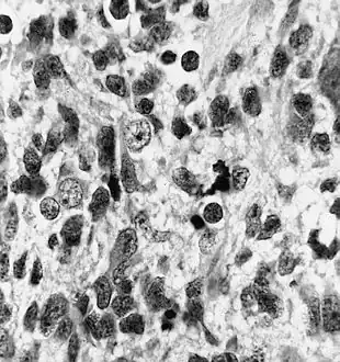 Neuronal differentiation, ranging from neuroblasts to ganglion cells, is seen in some medulloepitheliomas.