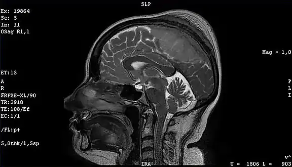 Meningioma of the middle third of the sagittal sinus with large hyperostosis