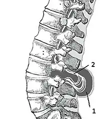 Myelomeningocele in the lumbar area(1) External sac with cerebrospinal fluid(2) Spinal cord wedged between the vertebrae