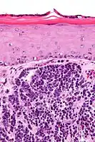 Micrograph of a Merkel-cell carcinoma. H&E stain