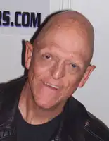 Actor Michael Berryman displays outward symptoms of the condition/Anhidrotic ectodermal dysplasia