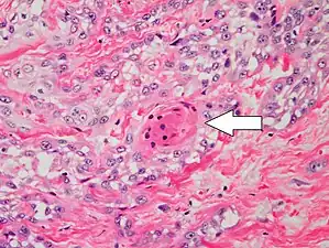 Poorly differentiated clear-cell squamous-cell carcinoma. For this type of cSCC, immunostains will likely be required to classify it unless other areas of the tumor show obvious squamous-cell features such as seen here (arrow).