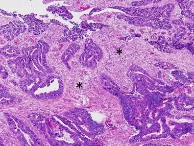 Colorectal carcinoma with desmoplastic reaction (*)