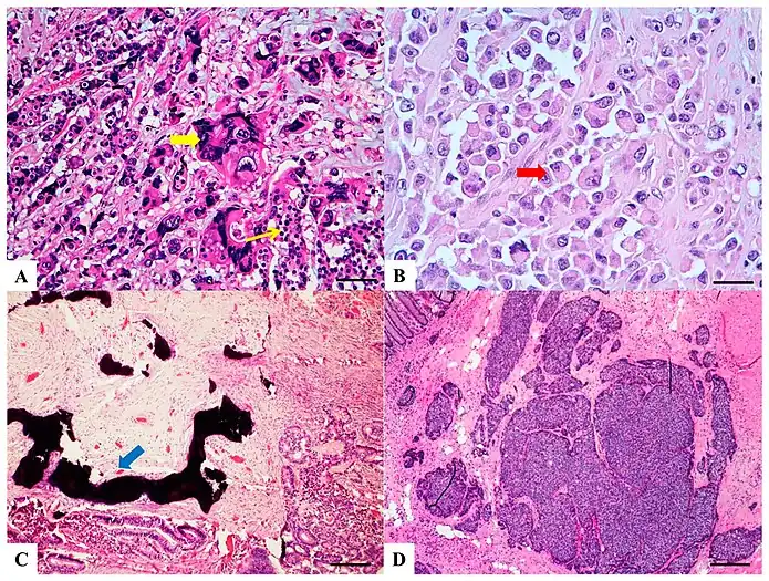 H&E stained sections(A) Colorectal choriocarcinoma: biphasic solid nests and trabeculae of mononucleated cells with clear cytoplasm (thin yellow arrow) and pleomorphic cells with abundant vacuolated or eosinophilic cytoplasm and single or multiple vescicular nuclei with conspicuous nucleoli (thick yellow arrow).(B) Rhabdoid colorectal carcinoma: rhabdoid cells characterized by a large, eccentrically located nuclei, prominent nucleoli (red arrow) and abundant eosinophilic cytoplasm. (C) Carcinoma with osseous metaplasia: osseous metaplasia (blue arrow) is recognized in conventional CRC as foci of bone formation in the stroma, with calcification, osteoid matrix, osteoclasts and osteoblasts.(D) Undifferentiated carcinoma: sheets of undifferentiated cells showing a variable grade of pleomorphism with no gland formation, mucin production or other line of differentiation.
