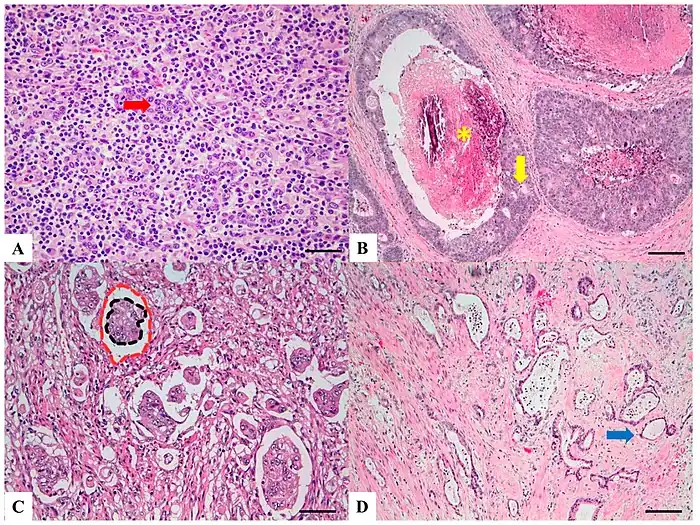 H&E stained sections:(A)Lymphoepitelioma-like carcinoma: Poorly differentiated cells (red arrow) arranged in solid nests, tubules and trabeculae with poorly demarcated, infiltrative margins; intratumoral lymphoid infiltrate is extremely abundant.(B) Cribiform comedo-type carcinoma: Cribriform gland (yellow arrow) with central necrosis comedo-like (yellow asterisk).(C) Micropapillary carcinoma: Small, tight round to oval cohesive clusters of neoplastic cells (>5 cells) floating in clear spaces (double circle red-black), without endothelial lining and with no evidence of inflammatory cells.(D) Low grade tubulo-glandular carcinoma: Very well-differentiated invasive glands with uniform circular or tubular profiles (blue arrow) with bland cytologic atypia.