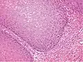 High magnification. There is prominent acanthosis. The tumor front is broad-based and pushes the subepithelial tissues.