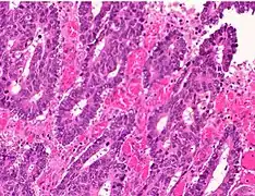 Poorly differentiated colorectal carcinoma