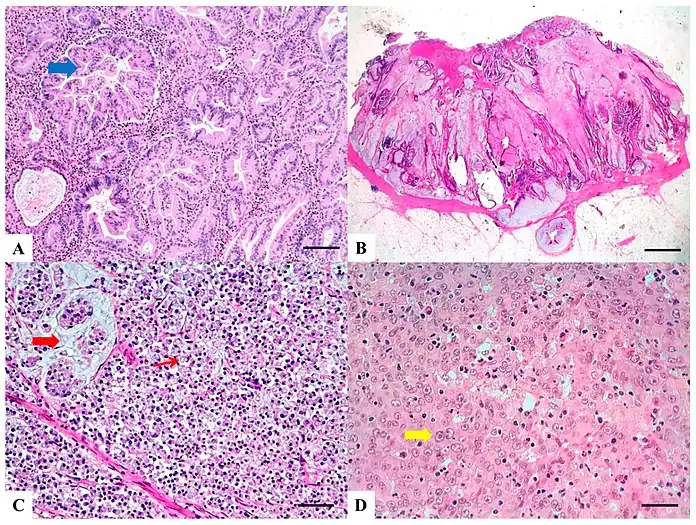 H&E stained sections: (A) Serrated adenocarcinoma: epithelial serrations or tufts (thick blue arrow), abundant eosinophilic or clear cytoplasm, vesicular basal nuclei with preserved polarity.(B) Mucinous carcinoma: Presence of extracellular mucin (>50%) associated with ribbons or tubular structures of neoplastic epithelium.(C) Signet ring carcinoma: More than 50% of signet cells with infiltrative growth pattern (thin red arrow) or floating in large pools of mucin (thick red arrow).(D) Medullary carcinoma: Neoplastic cells with syncytial appearance (thick yellow arrow) and eosinophilic cytoplasm associated with abundant peritumoral and intratumoral lymphocytes.