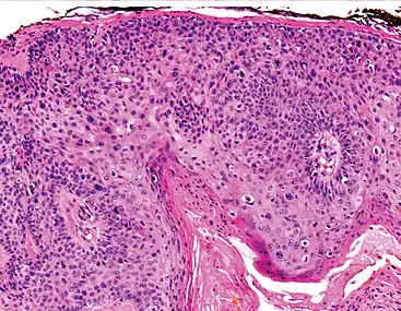 Squamous-cell carcinoma in situ, showing prominent dyskeratosis and aberrant mitoses at all levels of the epidermis, along with marked parakeratosis.