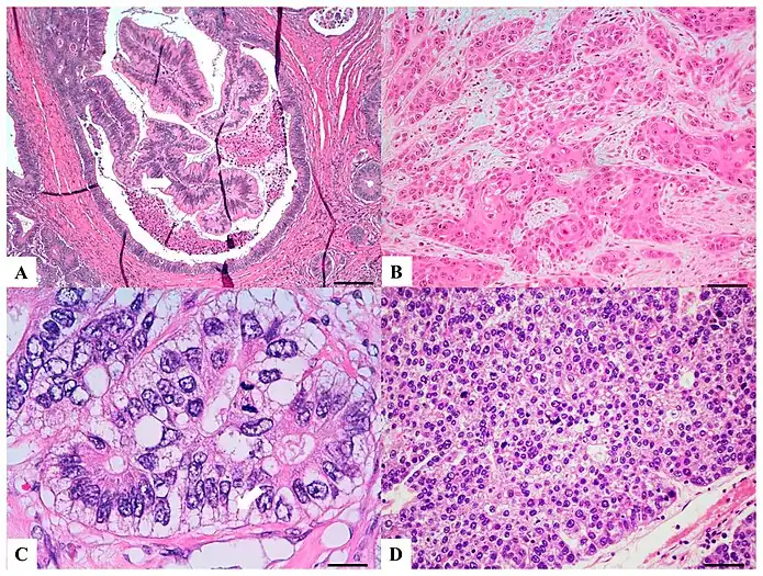 H&E stained sections:(A) Villous carcinoma: invasive carcinoma with villous features consisting of usually intraglandular papillary projections (yellow arrow) associated with an expansile growth pattern, at the deep portions of the tumor.(B) Squamous carcinoma: morphologically similar to other squamous cell carcinomas occurring in other organs with possible keratinization.(C) Clear cell carcinoma: clear cell cytoplasm identified in polygonal cells with a central nucleus, columnar cells with an eccentric nucleus (red arrow) and/or round/oval cells with abundant cytoplasm and inconspicuous marginally located nucleus similar to lipocytes or lipoblasts.(D) Hepatoid carcinoma: large polygonal-shaped cells, with granular eosinophilic cytoplasm, prominent nucleoli and trabecular and pseudo-acinar growth pattern similar to hepatocarcinoma.