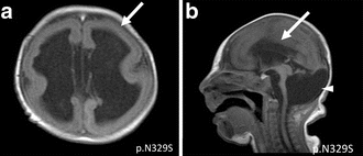 MRI of a patient with a TUBA1A mutation showing microlissencephaly with cerebellar hypoplasia. a. smooth brain surface (arrow) b. absent corpus callosum (arrow).