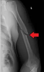 A transverse fracture of the humerus shaft