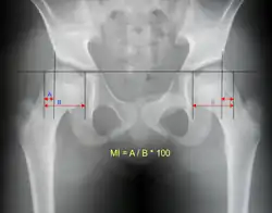 Reimer's migration index can be used to indicate hip dislocation. The migration index (MI) is normally less than 33%.