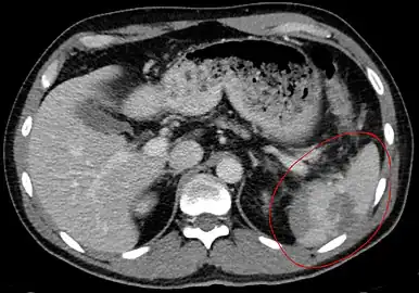 Traumatic rupture of the spleen on contrast enhanced axial CT (portal venous phase)
