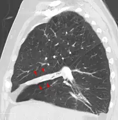 Atelectasis of the middle lobe on a sagittal CT reconstruction.