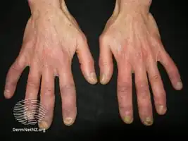 Mixed connective tissue disease